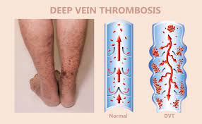 Deep vein thrombosis, anticoagulant therapy