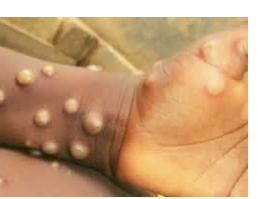 NCDC reports 60 suspected monkeypox cases