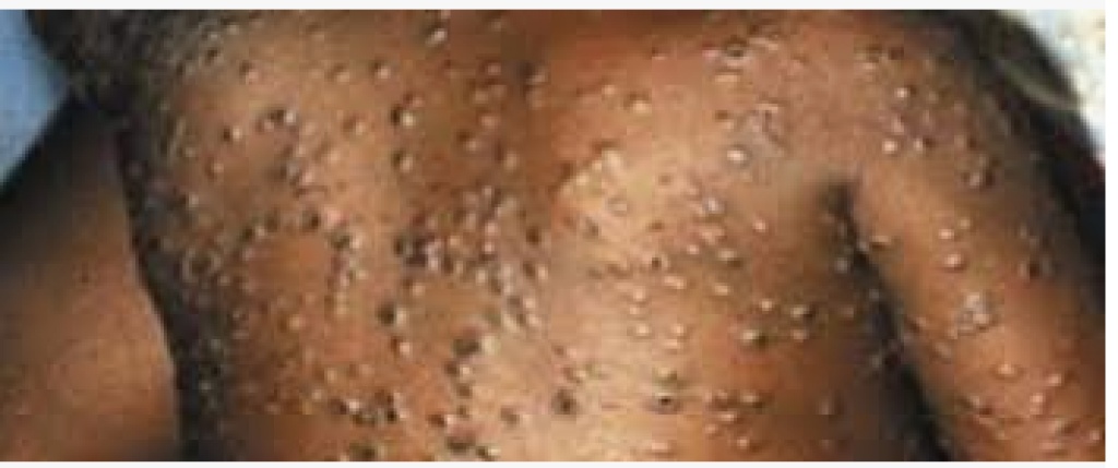 Abia confirms 9 cases of Monkey Pox